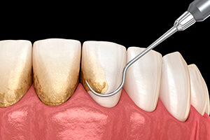 periodoncia03